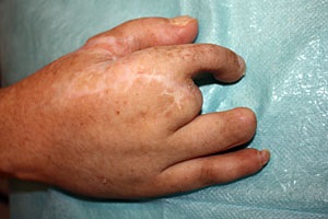 Recuperarea degetelor mâinii drepte