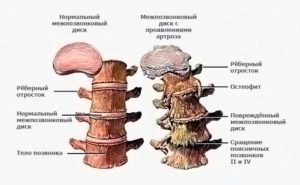 Moduri chirurgicale și conservatoare de tratare a osteocondrozei, o nouă etapă