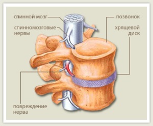 Moduri chirurgicale și conservatoare de tratare a osteocondrozei, o nouă etapă