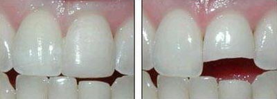 Restaurarea artistică a dinților pe ceea ce este capabil să corecteze mușcătura și brațele