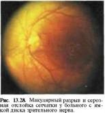 Foveea nervului optic al nervului optic