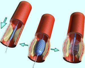 Vindecarea rănilor după stent