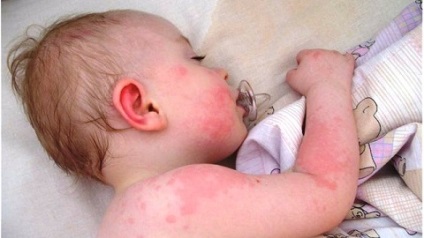 Dermatita alergica la copii, simptome si tratament, arata ca - vii sanatosi!