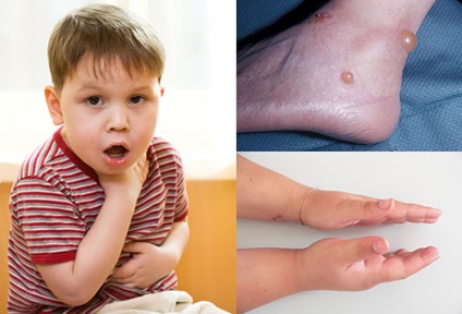 Alergia la insecte simte simptome și moduri de tratament