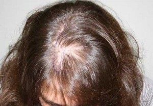 Alopecia la femei - factorii principali ai pierderii severe a părului