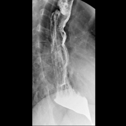 Achalasia cardiografiei esofagului