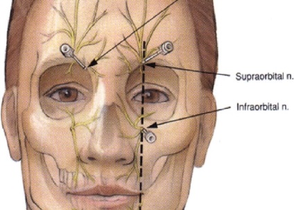 Blocarea ramurilor nervului trigeminal