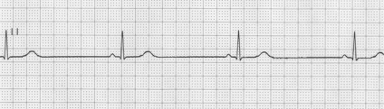 Bradycardia sportolók különösen, kezelésére és megelőzésére