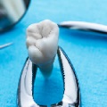 Decât să clătească o gură după extragerea unui dinte pentru o vindecare rapidă