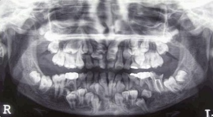 Diastoza cranio-claviculară (displazie, sindromul syithauera-mari-senton) simptome și tratament