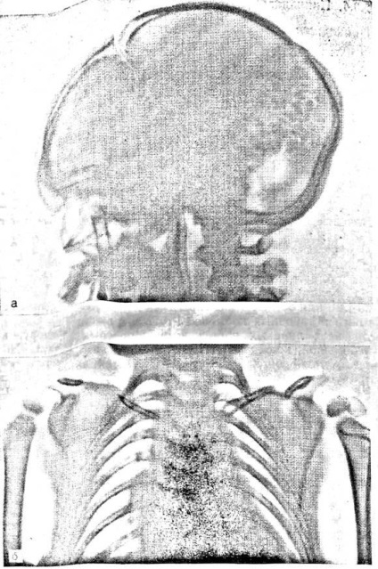 Dysostoza cranio-claviculară - diagnosticul clinic și radiologic al displaziei scheletice