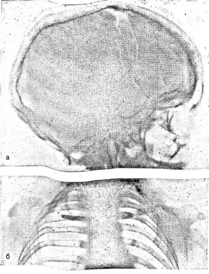 Dysostoza cranio-claviculară - diagnosticul clinic și radiologic al displaziei scheletice