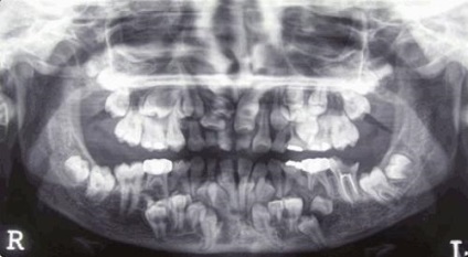 Simptomele disostozei cranio-claviculare și tratamentul patologiei