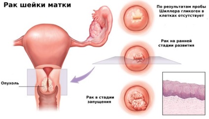 Ce este o proteină de rinichi?