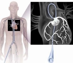 Ce este angiografia coronariană sau angiografia?