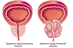DGP 2 grade de tratament pentru adenomul de prostată