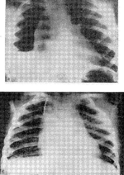 Diagnosticul pleureziei purulente