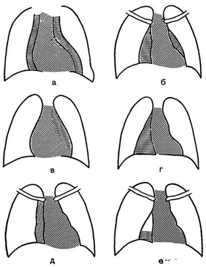 Diagnosticul pleureziei purulente