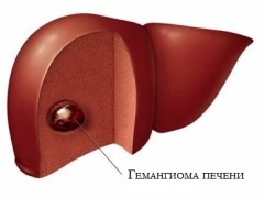 Hemangiomul hepatic, clinica hirudoterapie - tratamentul cu lipitori de la Kiev