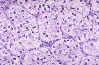 Tipuri histologice de cancer renal