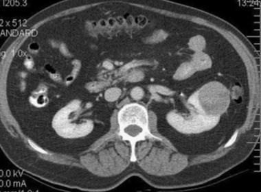 Tipuri histologice de cancer renal