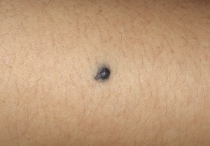 Blue nevus - fotografie, motive pentru aspect, derm-info