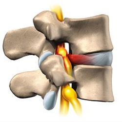 Discuri herniate