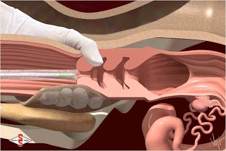 Inseminarea artificială