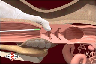 Inseminarea artificială