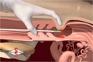 Inseminarea artificială