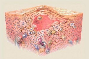 Vindecarea glandei tiroide și a eczemelor
