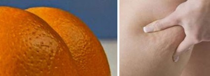 Cum sa scapi de coaja de portocala pe piele