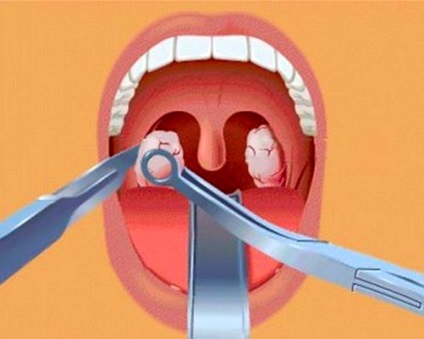 Cum să eliminați adenoizii la copii