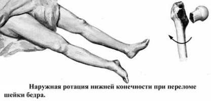 Osztályozása a csípőtáji törések (femur) Osztályozása törések a csípő
