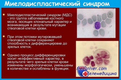 Myelodysplastic szindrómák klinikája