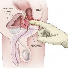 Tratamentul adenomului prostatic și metodele moderne de diagnosticare