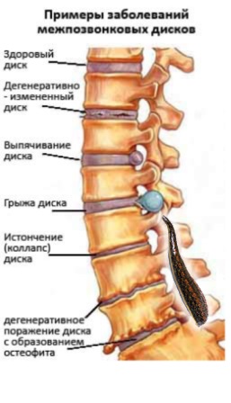 Tratamentul coloanei vertebrale (osteoporoza, fracturi de compresie, hemangioame) în Israel