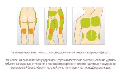 Lipomodelirovanie, lipomodelirovanie electronică, lipolyfting, răspunsuri lipomodelirovanie,