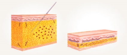 Lipomodelirovanie, lipomodelirovanie electronică, lipolyfting, răspunsuri lipomodelirovanie,