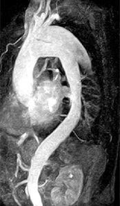 Anangiografia cu rezonanță magnetică în diguri