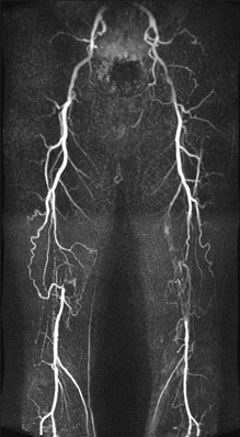 Anangiografia cu rezonanță magnetică în diguri