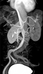 Anangiografia cu rezonanță magnetică în diguri