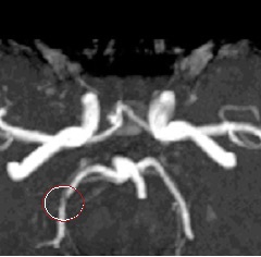 Anangiografia cu rezonanță magnetică în diguri