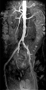 Anangiografia cu rezonanță magnetică în diguri