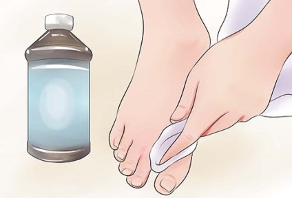 Remedii populare pentru ciuperca unghiilor la picioare