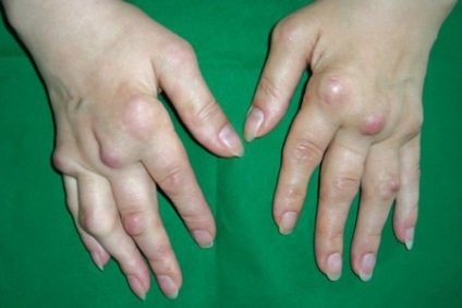 Plăcuțele pe articulațiile degetelor