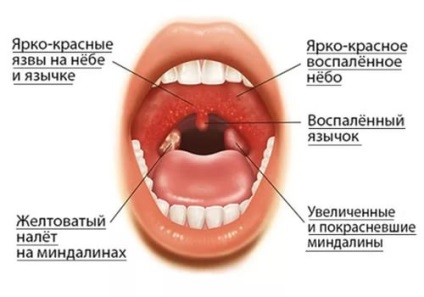 Angina pectorală necrotică, simptome și tratament