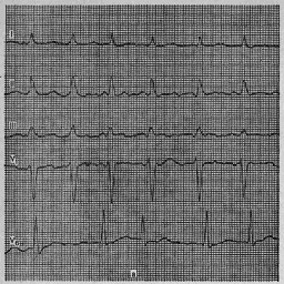 Îngrijire de urgență pentru paroxisme de flicker și flutter atrial