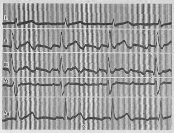 Îngrijire de urgență pentru paroxisme de flicker și flutter atrial