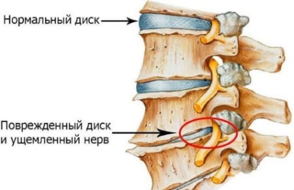 Osteocondroza și comunicarea și tratamentul aritmiei cardiace